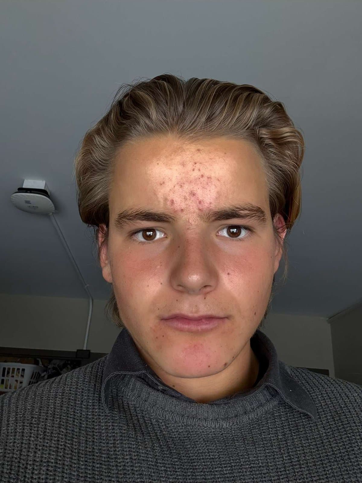 Before: close-up of my face with inflamed acne on the forehead